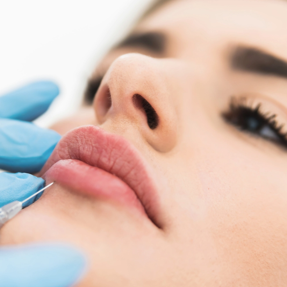 uucp-lip-filler-2